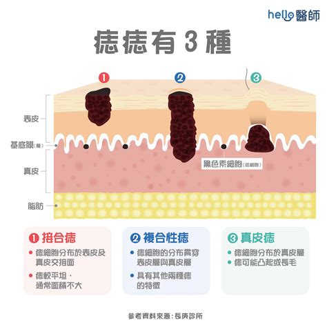 痣為什麼會凸起來|為什麼臉上的痣越來越多？皮膚科醫師解析長痣原因、。